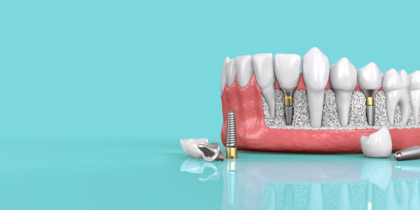 Зубной имплант dentis