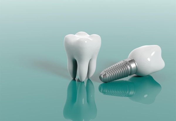Имплантация зубов Осстем