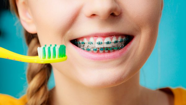 Зубные брекеты для детей