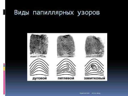 Петля ульнарная и радиальная
