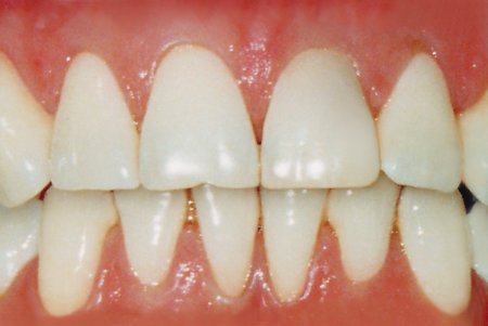 Tooth 3d Zbrush
