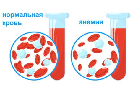 Железодефицитная анемия рисунок