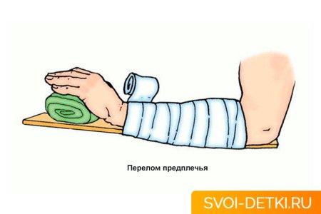 Иммобилизация конечности при переломе костей кисти и пальцев