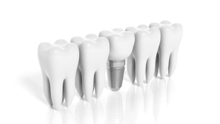 Имплантаты Dentium