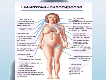 Что такое гипотиреоз щитовидной железы у женщин
